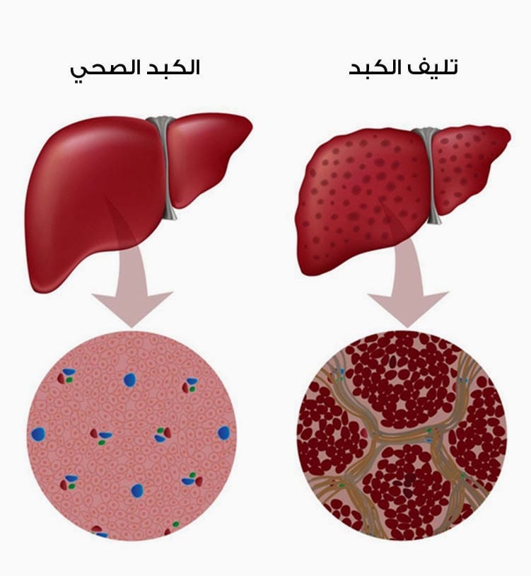 معلومات عن التهاب الكبد الفيروسي، إلتهاب الكبد من الأمراض صعبة العلاج 149345 1