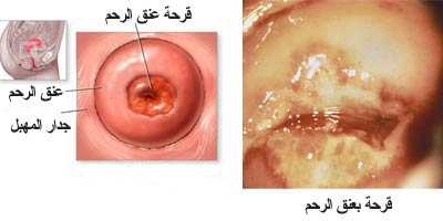 اعراض قرحة الرحم Fddc342A1A04E832Cab0458Cca0C4Ea4