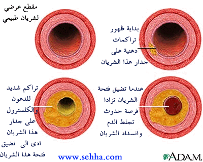 انسداد شرايين الراس