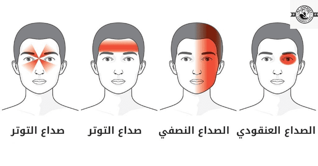 تجربتي مع صداع التوتر، اضطرابات الدماغ والتوتر العصبي 149414 1