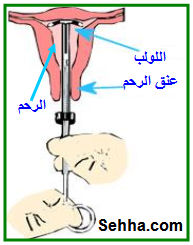 طريقة تركيب اللولب ، تعرفي علي كل ما يخصه و ماهي اضراره و فوائده 20531 1