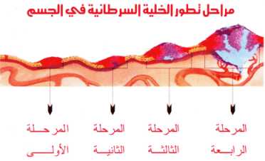 انواع الاورام 444