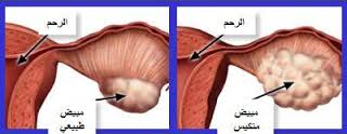 تكيس المبايض والحمل بالصور