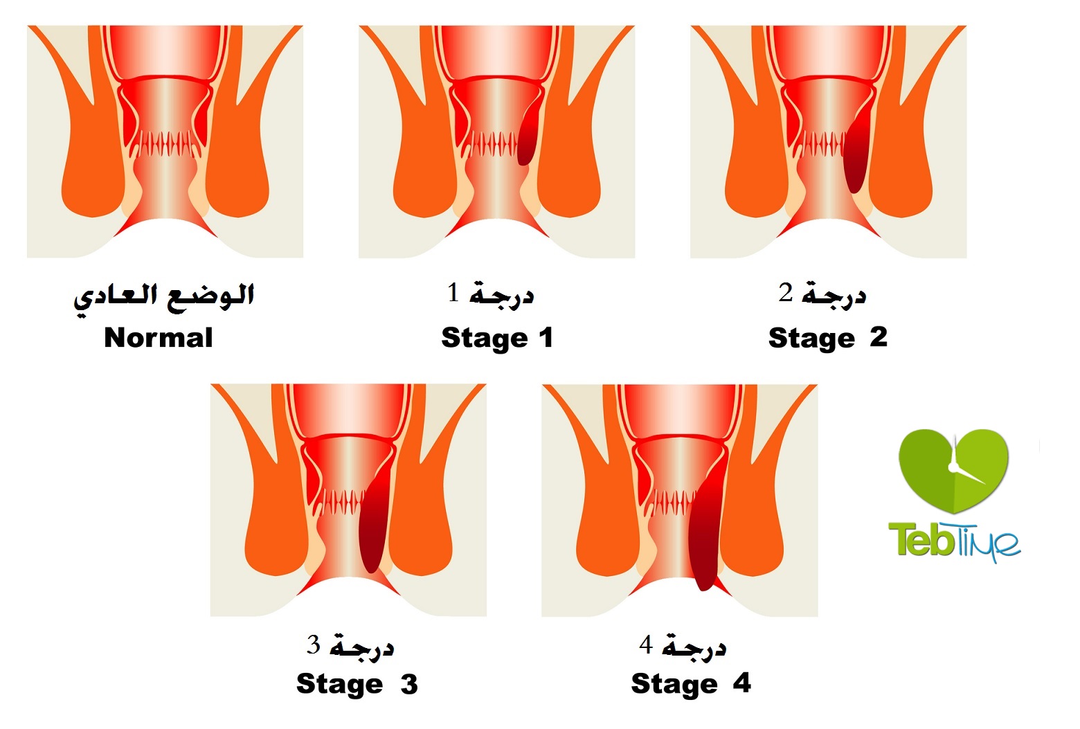 كيف نوقف نزيف البواسير - هخليكى تعالجى نزيف البواسير بخطوات سهلة وبسيطه 19089