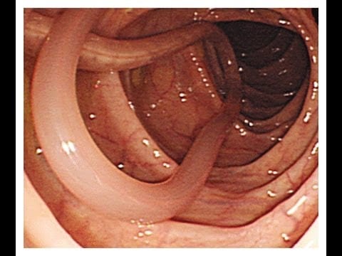 علاج دود الامعاء