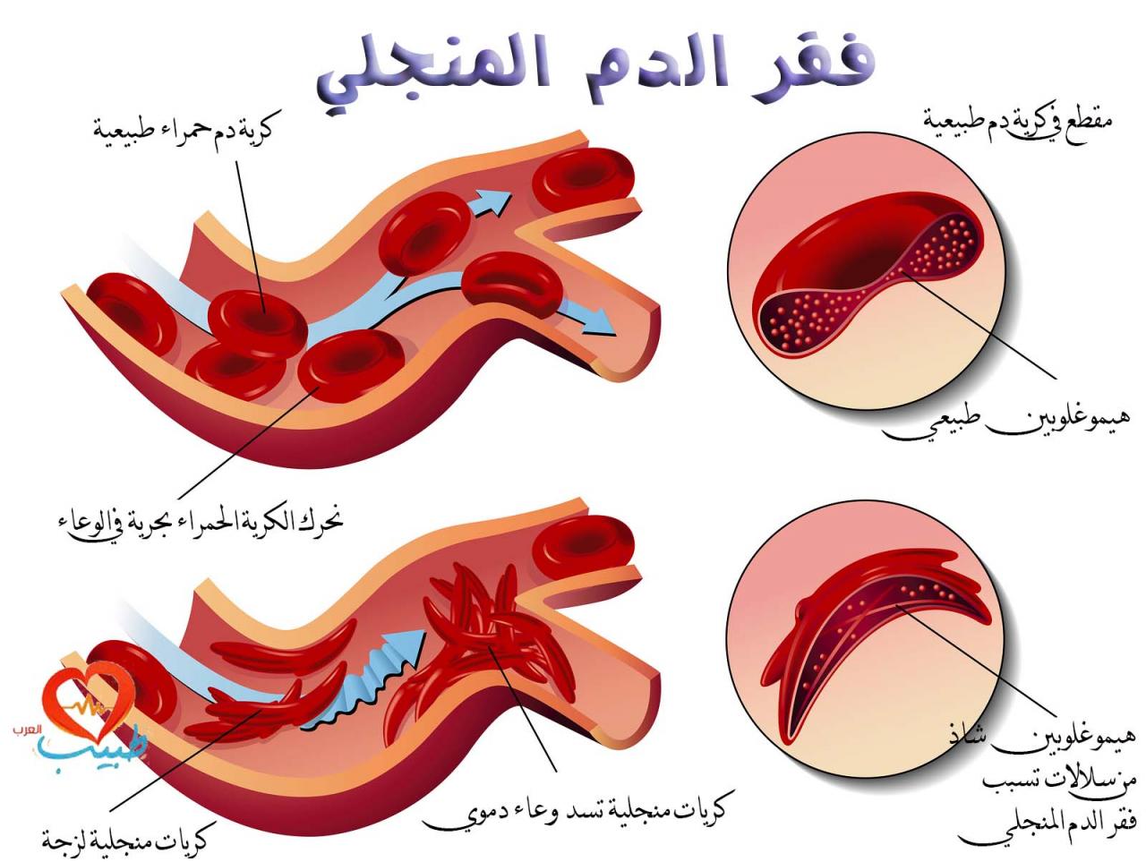 علاج الانيميا المنجلية- كيفية القضاء على الانيميا 74703