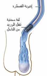 علاج دوالى الخصية