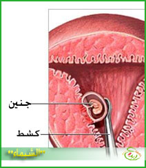 كحت الرحم