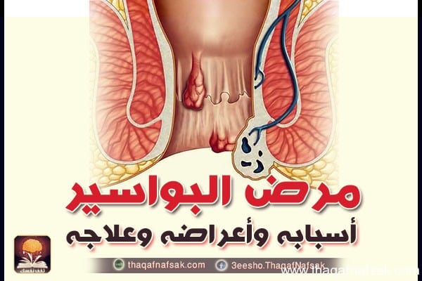 مرض العذر عند الرجل , تعرفى على اسباب البواسير وكيفيه العلاج بسهوله