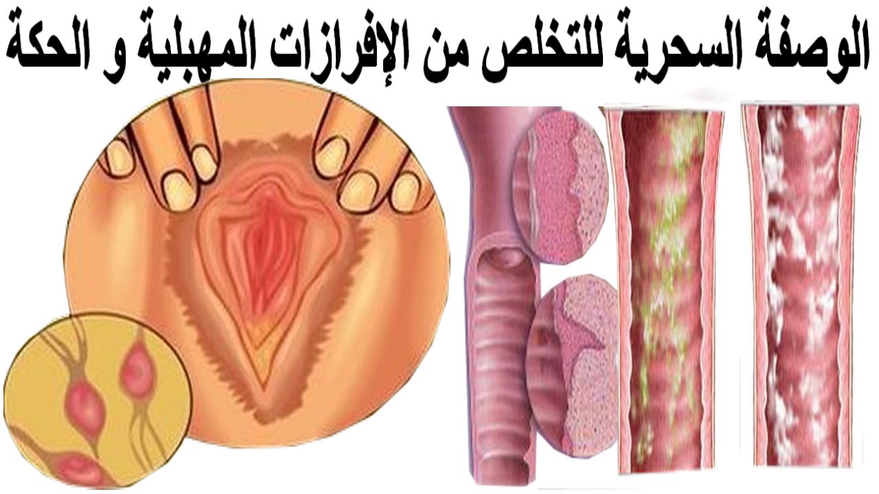 على ماذا يدل كثرة الافرازات المهبلية , كثرة الافرازات المهبلية