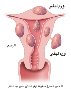 اورام ليفية