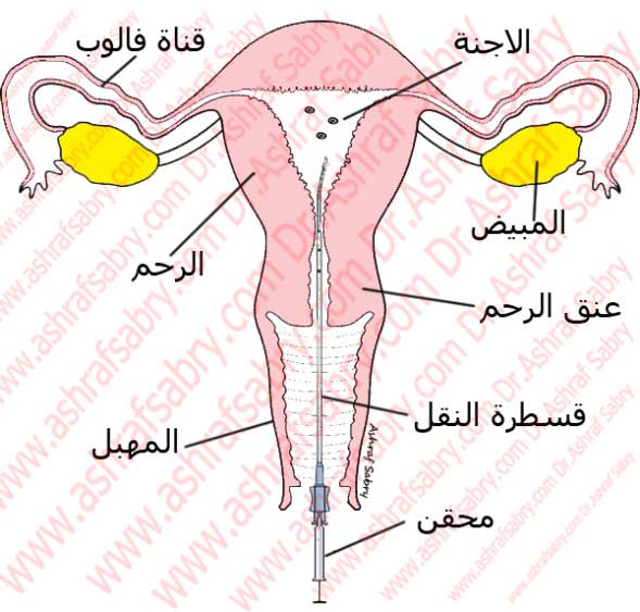 الاجنه المجمده من الدرجه الاولى