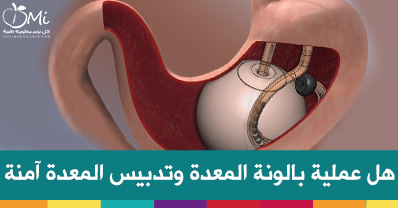 اضرار عملية تدبيس المعدة