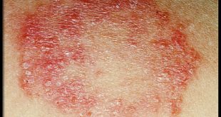 التهابات فطرية القوباء الحلقية من الامراض الجلدية 310x165