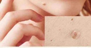 5 كريمات للتخلص من الشامات السطحية وعلامات الجلد، علاجات للشامة في البشرة 149316 1 310x165